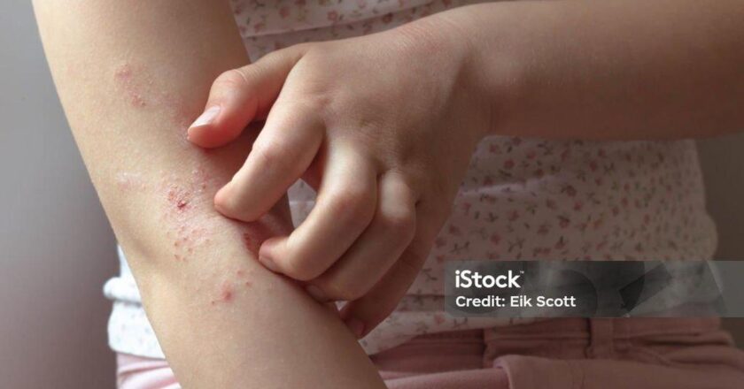 Süt alerjisinin belirtileri nelerdir? Süt alerjisi nasıl anlanır? Tedavi yöntemleri nelerdir?